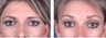 Brow lift at age 39