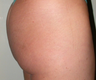 Fat Transfer