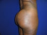 36 year old Brazilian Butt Lift - second view