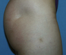 Fat Transfer