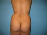 Buttock augmentation (Brazilian buttock lift)