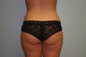 Buttock Augmentation (Fat Transfer)