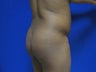 27 year old fat grafting to butt and hips - second view