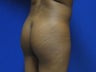 31 year old Brazilian Butt Lift - side view