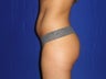 34 year old Brazilian Butt Lift - second view