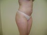 Buttock Implants