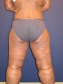massive weight loss with significant skin excess and laxity of buttock