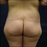 Butt Lift