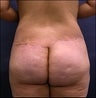 Butt Lift