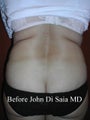 Butt Lift in a prior Tummy Tuck Patient 