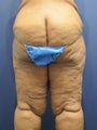 massive weight loss with significant skin excess and laxity of buttock