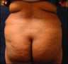 Butt Lift