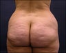 Butt Lift