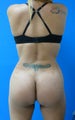 Brazilian Butt Lift