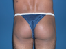 Buttock augmentation with implant