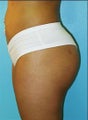 Butt Augmentation