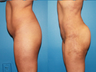 Buttock Augmentation with fat transfer, liposuction abdomen and hips