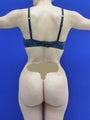 Butt Augmentation