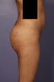 Buttock augmentation 