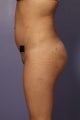 Buttock augmentation
