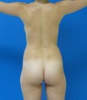 Brazilian butt Lift
