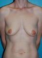 Breast Implants
