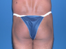 Buttock augmentation with implant