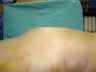 Butt Augmentation, Liposuction