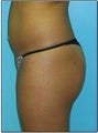 Butt Augmentation