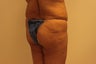 Butt augmentation