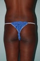 Buttock Augmentation