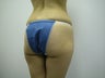 Brazilian Butt Lift