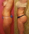Brazilian buttock augmentation with fat grafting to the buttocks with liposuction in Los Angeles