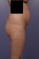 Buttock augmentation 