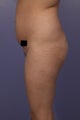 Buttock augmentation