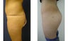 Buttocks Implants