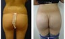 Buttocks Implants