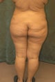 Women's Buttocks Augmentation 