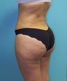Brazilian Butt Lift- Fat Transfer