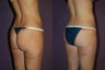 Butt Lift