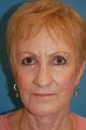 Co2 Laser Skin Resurfacing
