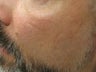 CO2 Fractionated Laser Resurfacing.
