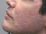 CO2 Fractionated Laser Resurfacing