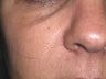 CO2 Fractionated Laser Resurfacing