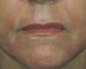 Ridding Lip Lines & Wrinkles with C02 Laser
