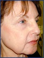 CO2 laser skin resurfacing