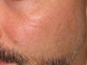 CO2 Fractionated Laser Resurfacing.