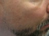CO2 Fractionated Laser Resurfacing