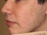CO2 Fractionated Laser Resurfacing