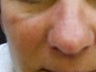 CO2 Fractionated Laser Resurfacing